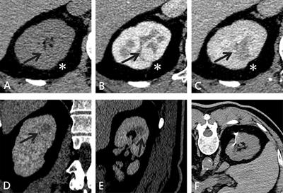 Percutaneous Microcoil Localization of a Small, Totally Endophytic Renal Mass for Nephron-Sparing Surgery: A Case Report and Literature Review